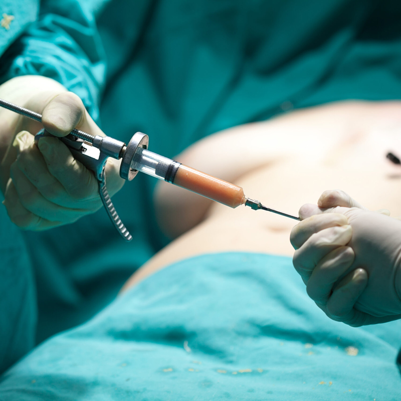 Lipofilling